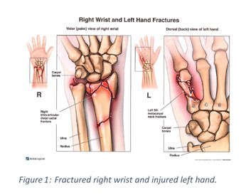 hand fracture