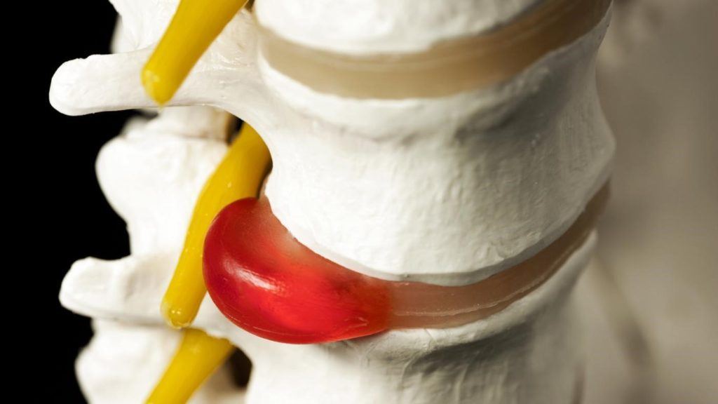 Herniated or Bulging Disc from Accident (Neck, Back, Spine Injury)