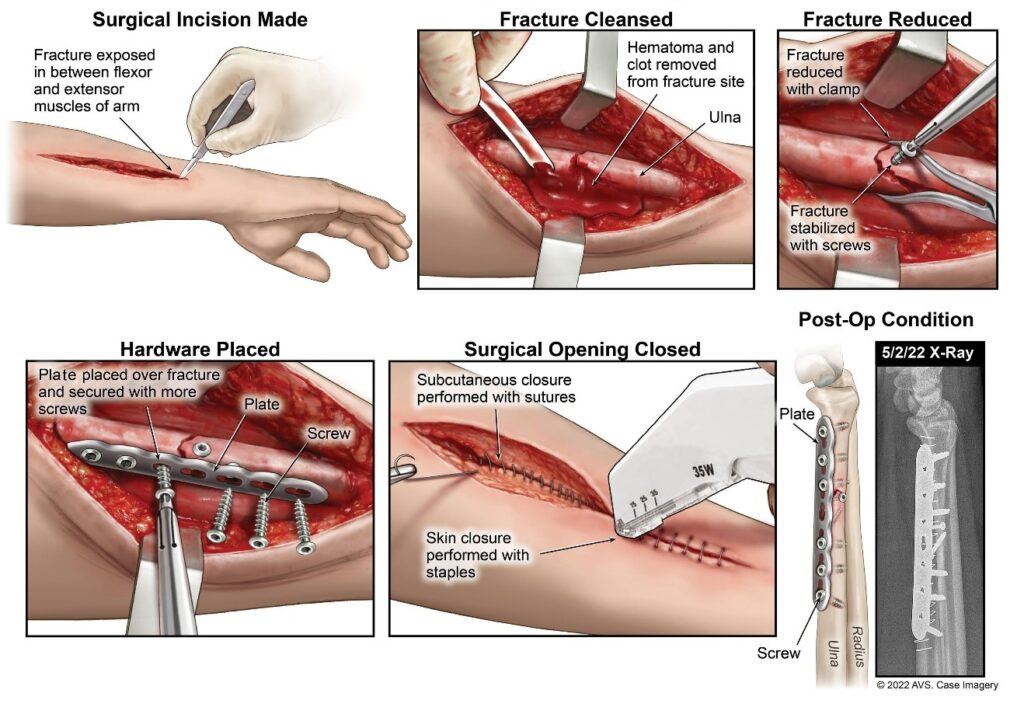 Mr. Ramos’ first surgery to repair his broken wrist