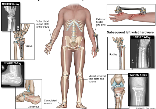 Illustration of Mr. Simmons’ surgical hardware 